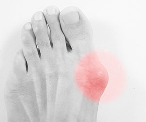 Ratgeber Hallux valgus entstehung Fehlstellung Großzehgrundgelenk